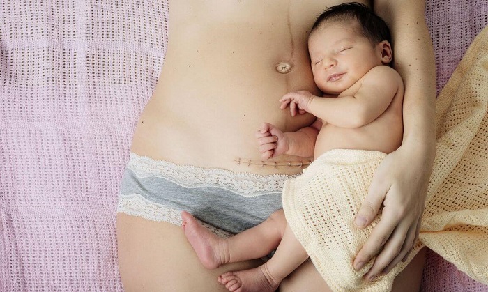 Sinh mổ không ảnh hưởng gì đến việc tiếp xúc da kề da của mẹ và em bé1
